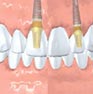 Tooth Replacement